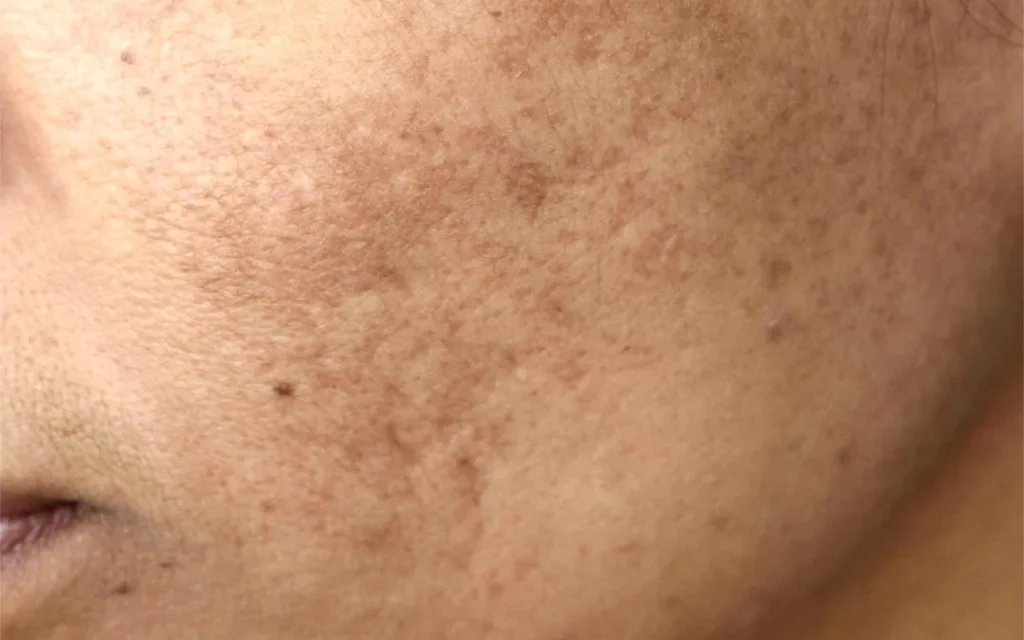 melasma