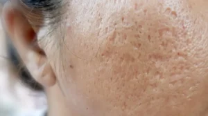 acne scar