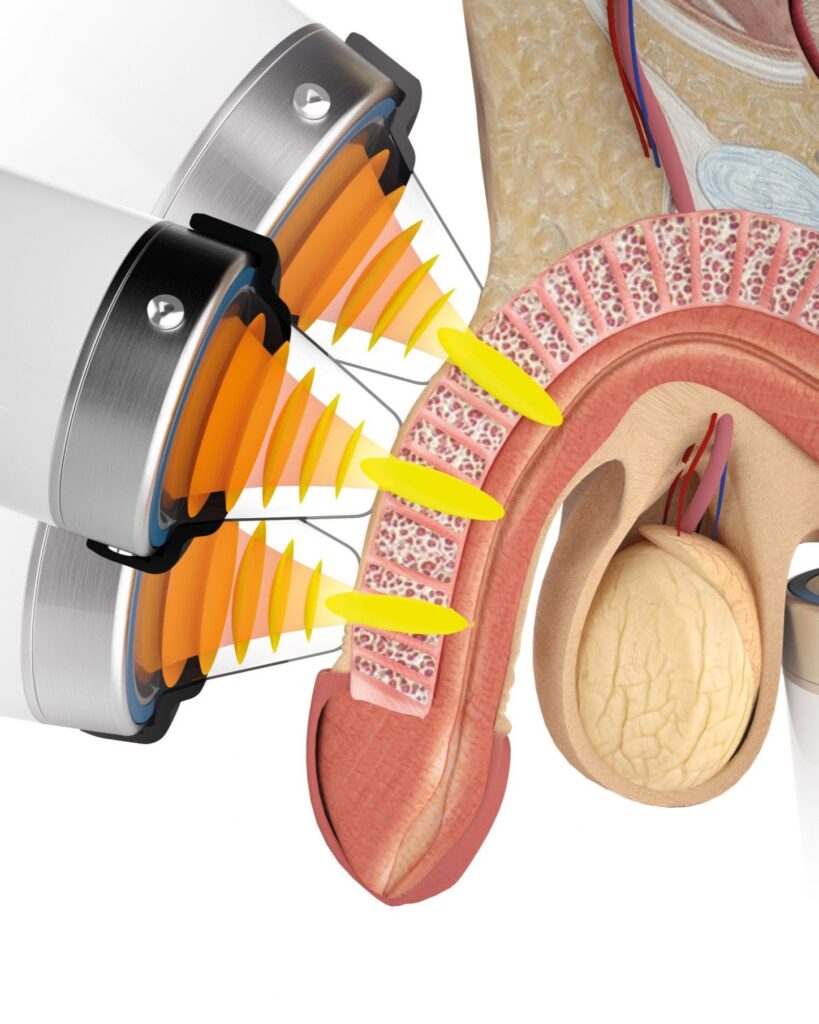 shockwave erectile dysfunction