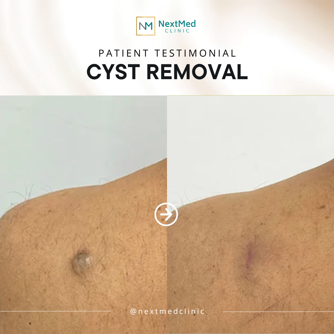 CYST (1)