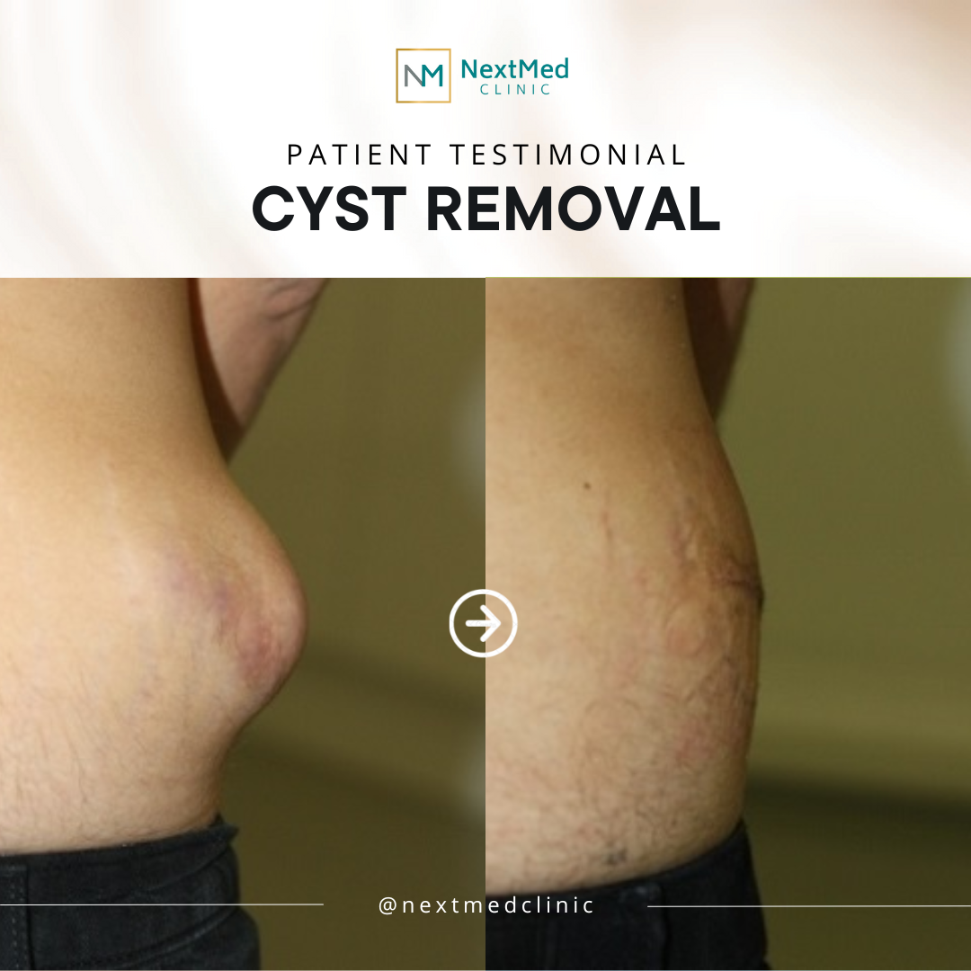 CYST (3)