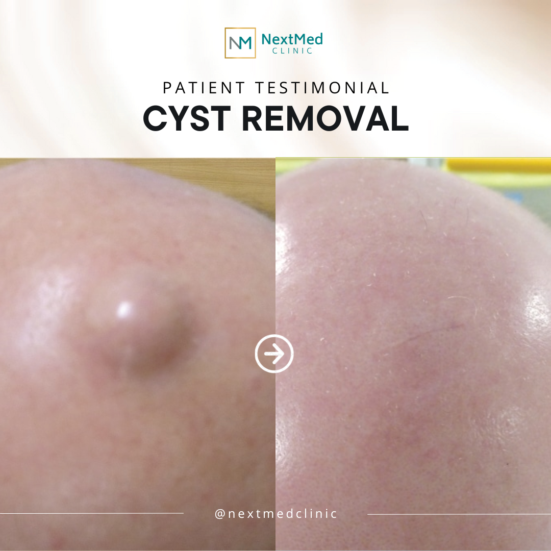 CYST (4)