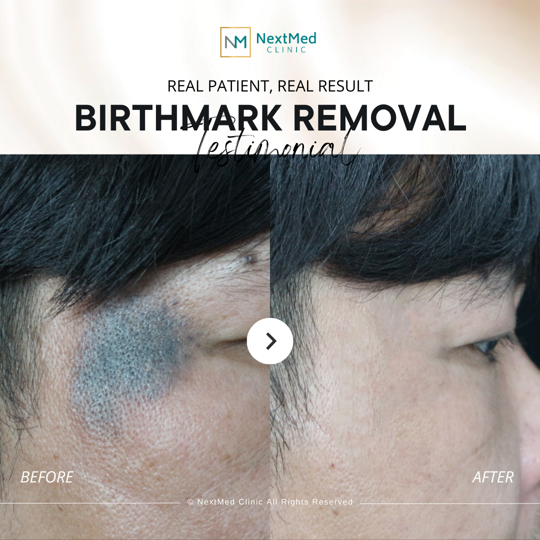 birthmark before after (1)