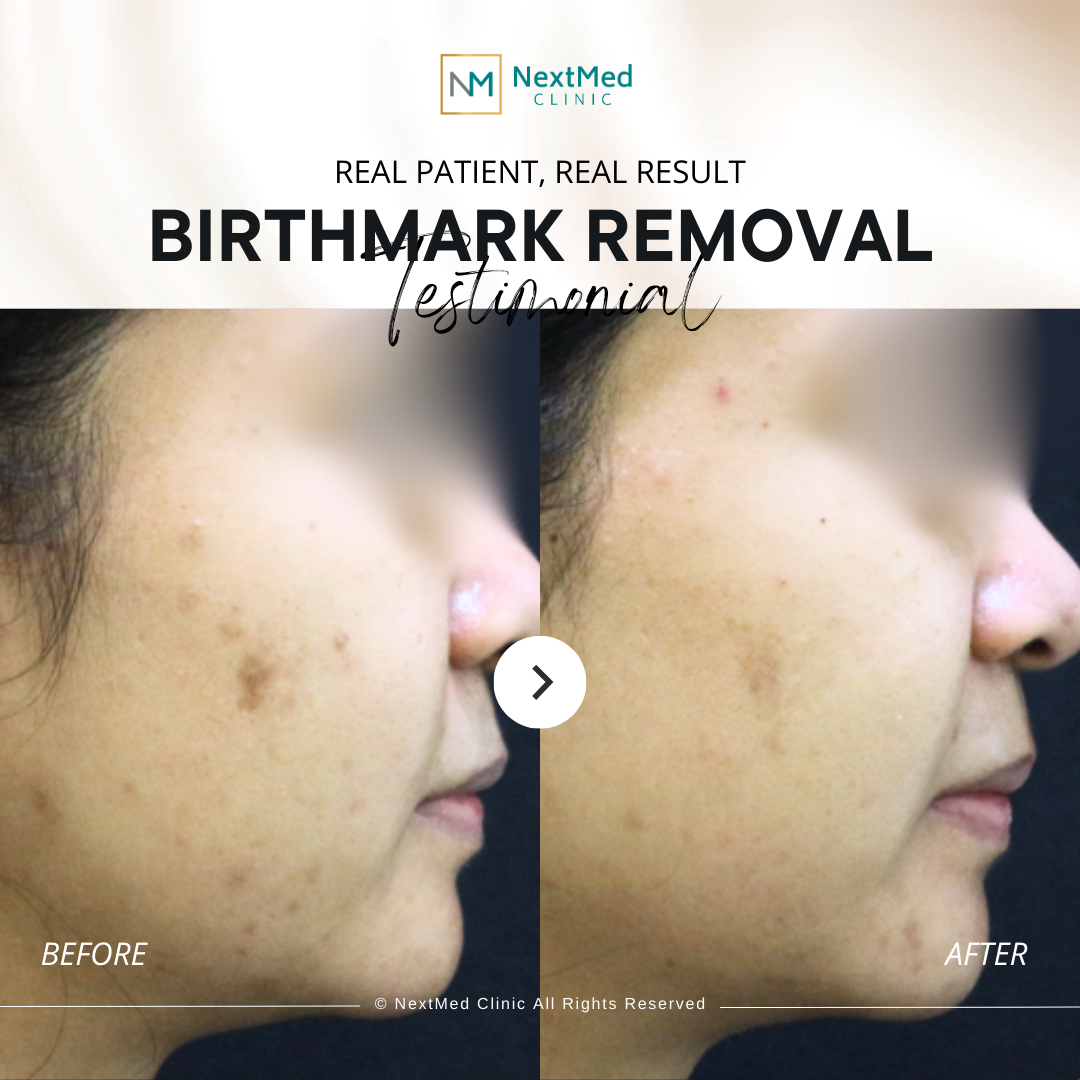 birthmark before after (2)