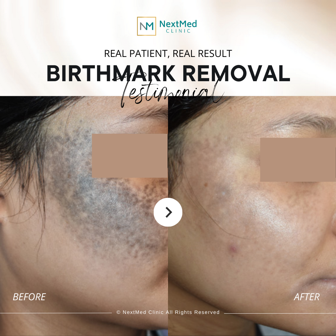 birthmark before after (3)