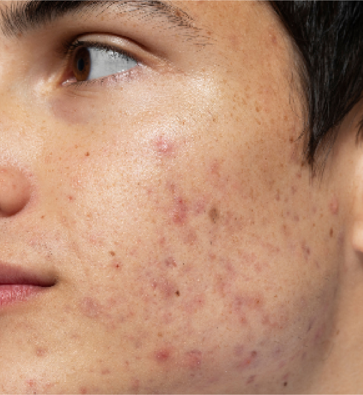 acne scar