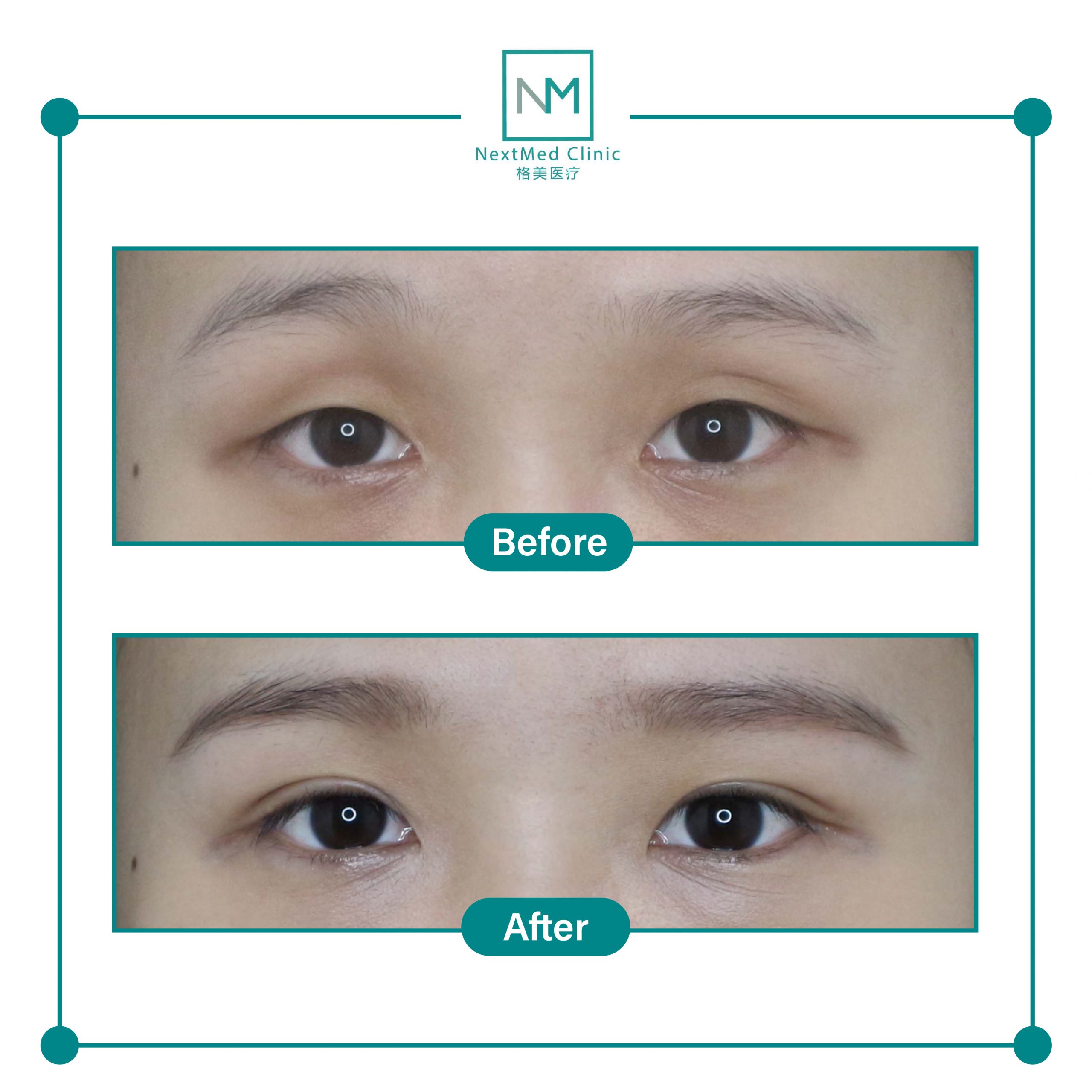 nextmed-clinic-double-eyelid-suture-01-scaled-1.jpg