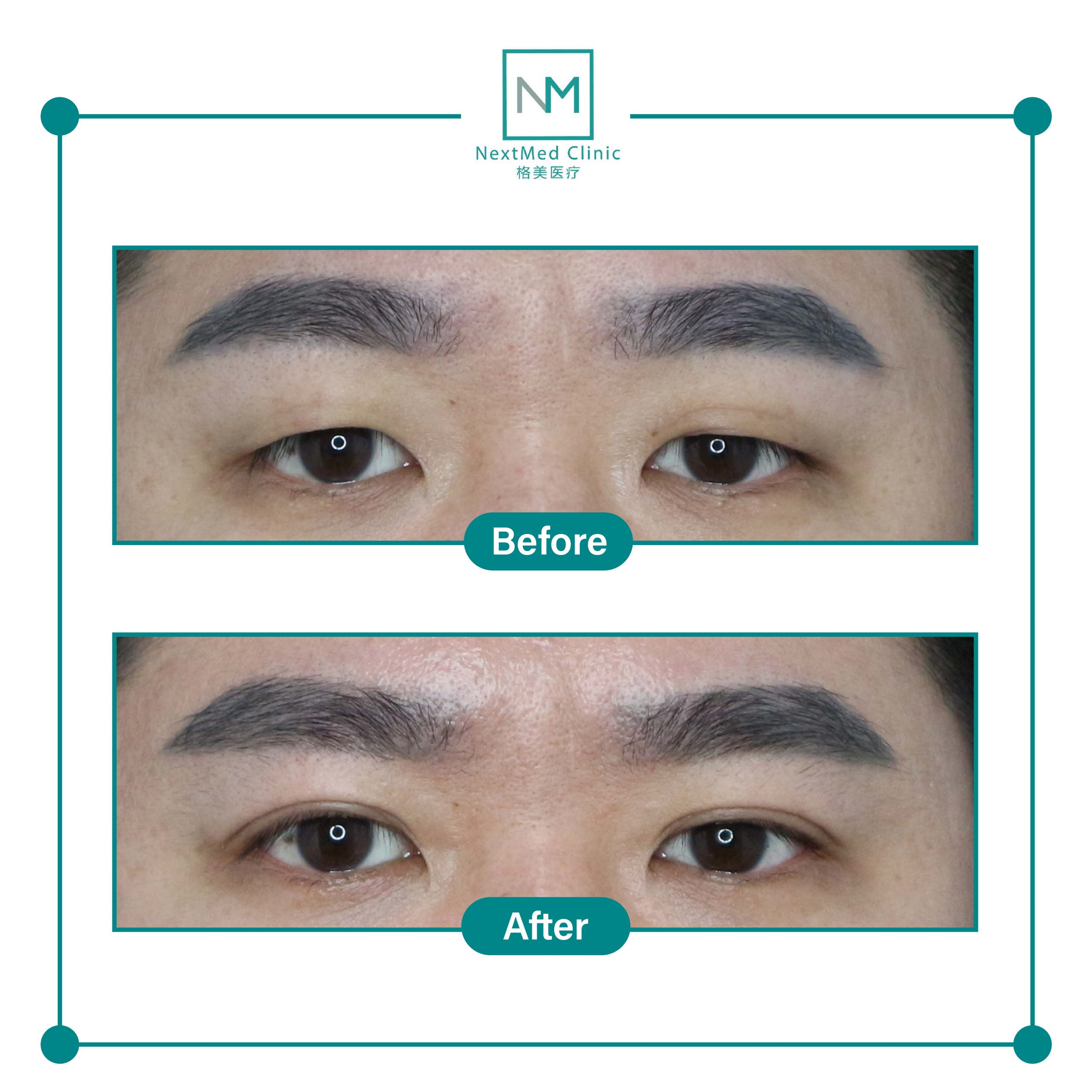 nextmed-clinic-double-eyelid-suture-03-scaled-1.jpg