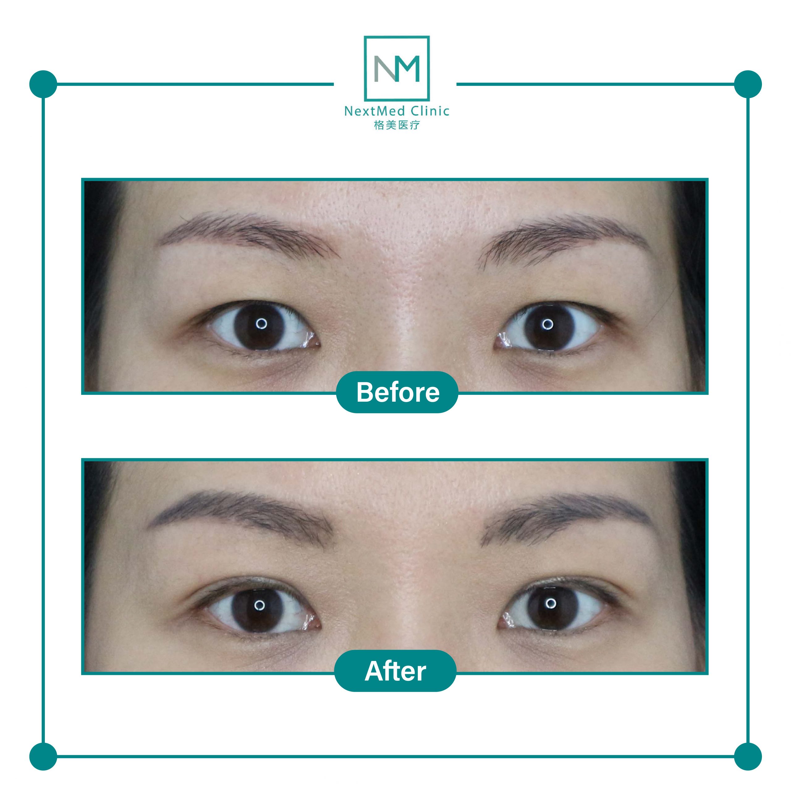 nextmed-clinic-double-eyelid-suture-04-scaled-1.jpg