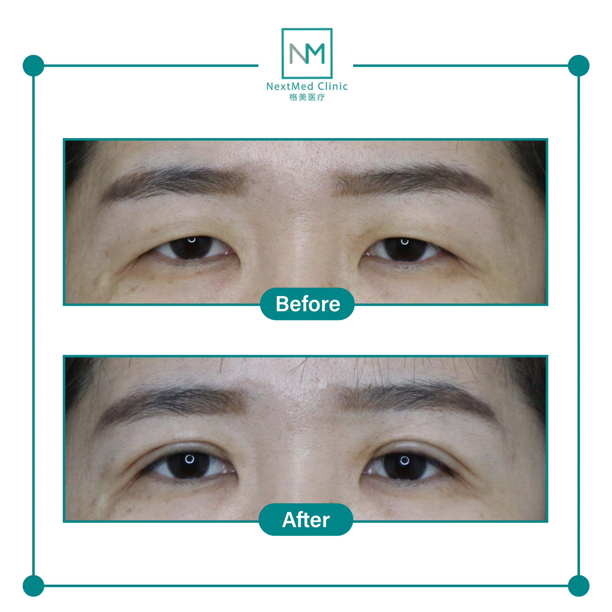 nextmed-clinic-double-eyelid-suture-05-scaled-1.jpg