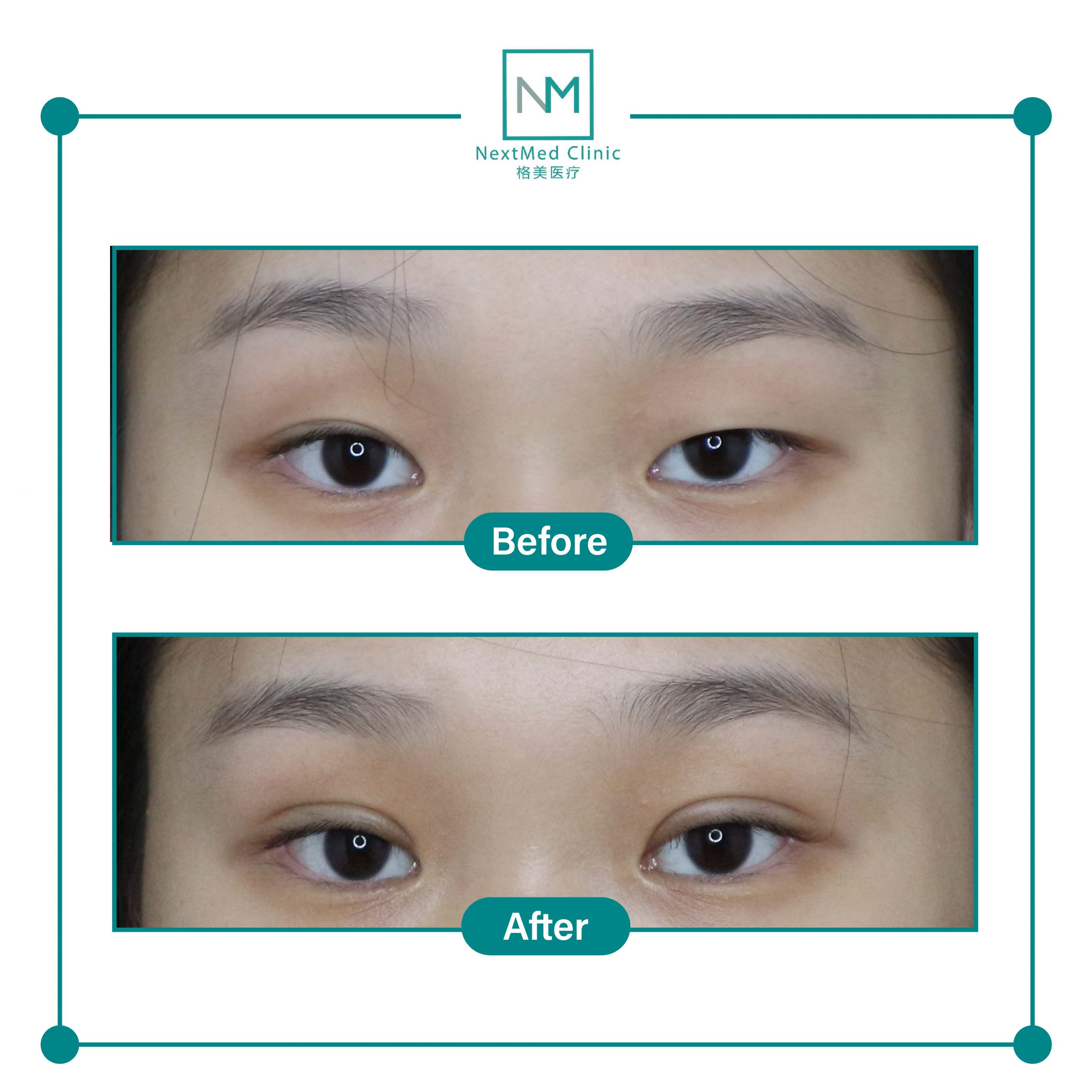 nextmed-clinic-double-eyelid-suture-07-scaled-1.jpg