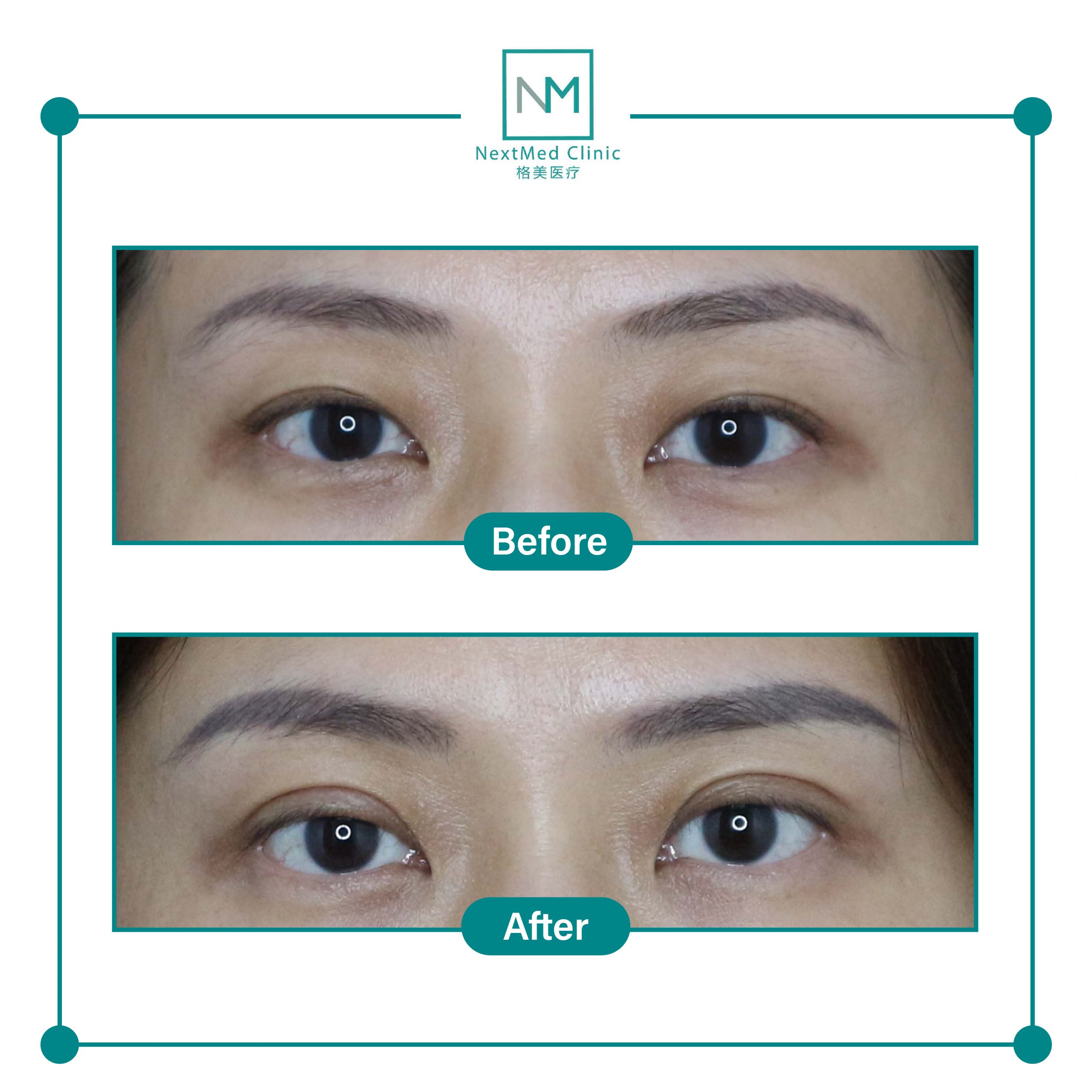 nextmed-clinic-double-eyelid-suture-08-scaled-1.jpg