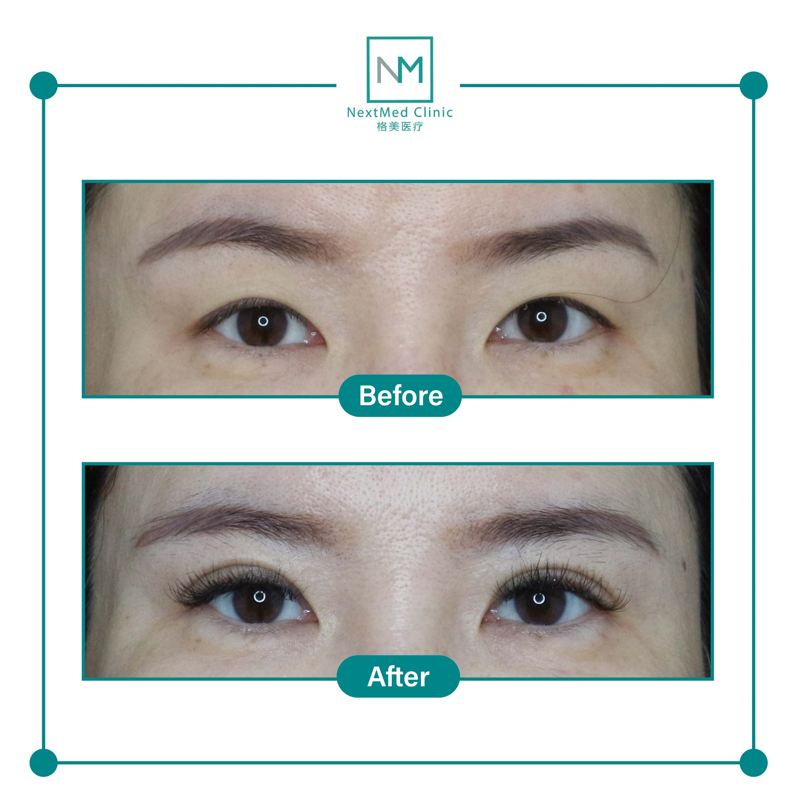 nextmed-clinic-double-eyelid-suture-09-scaled-1.jpg