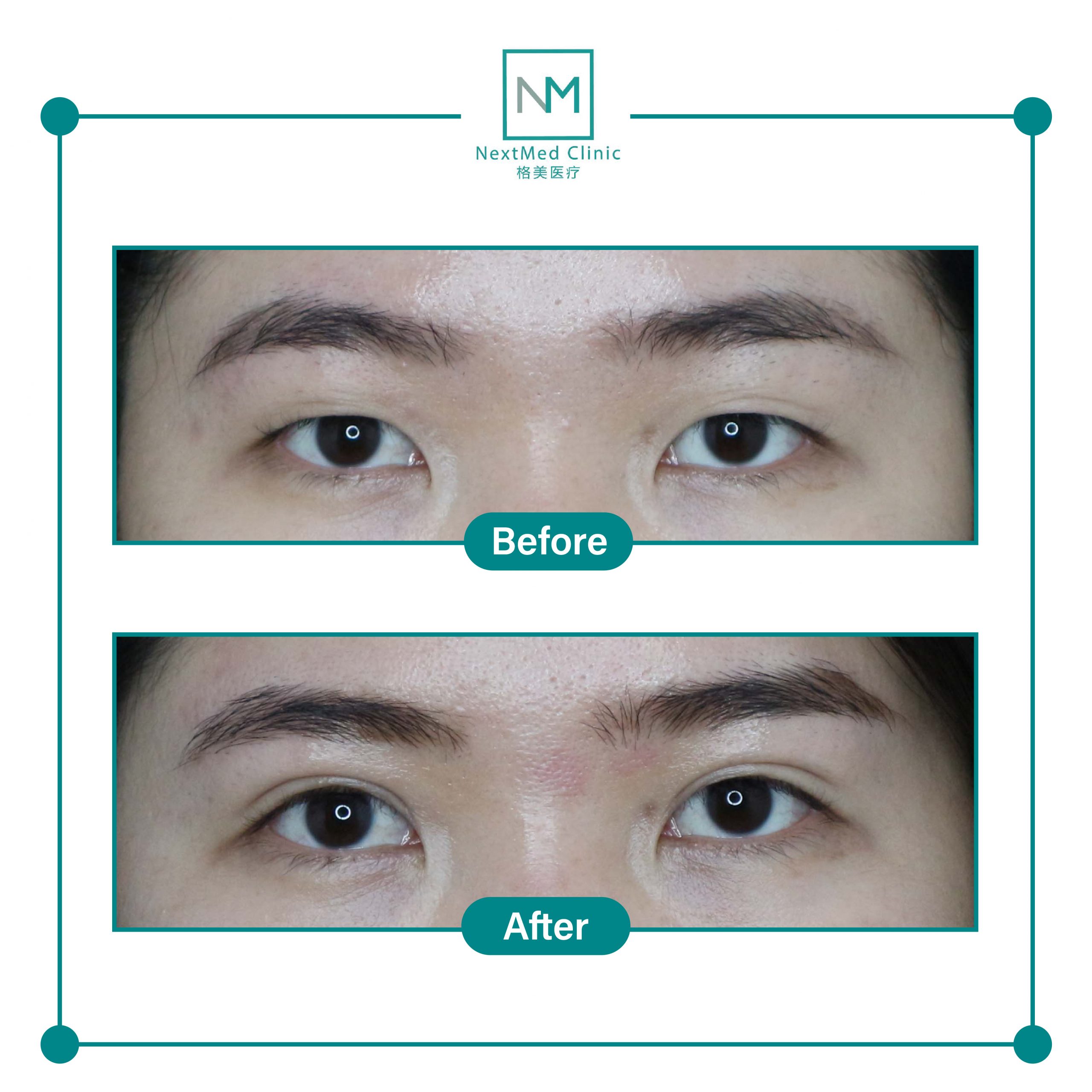 nextmed-clinic-double-eyelid-suture-10-scaled-1.jpg