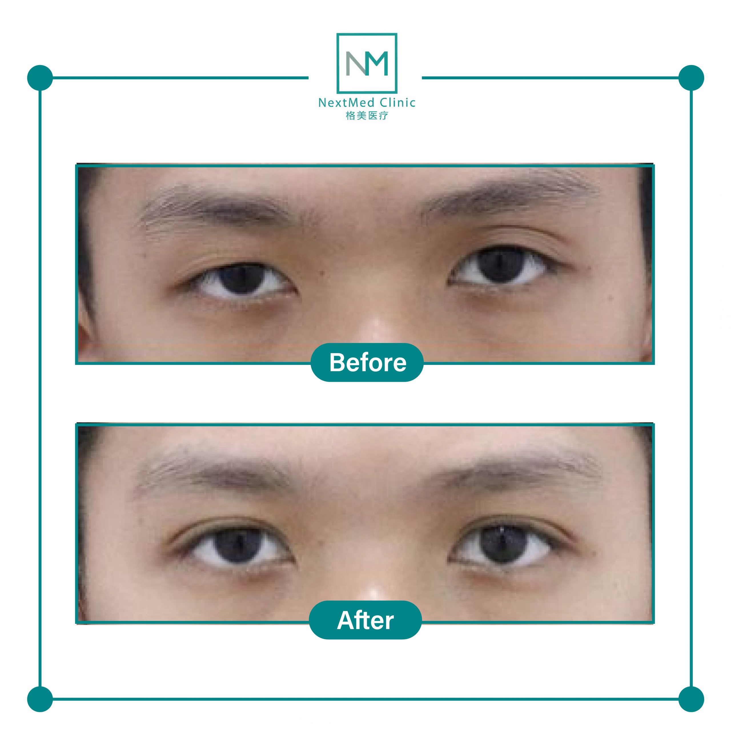 nextmed-clinic-double-eyelid-suture-14-scaled-1.jpg