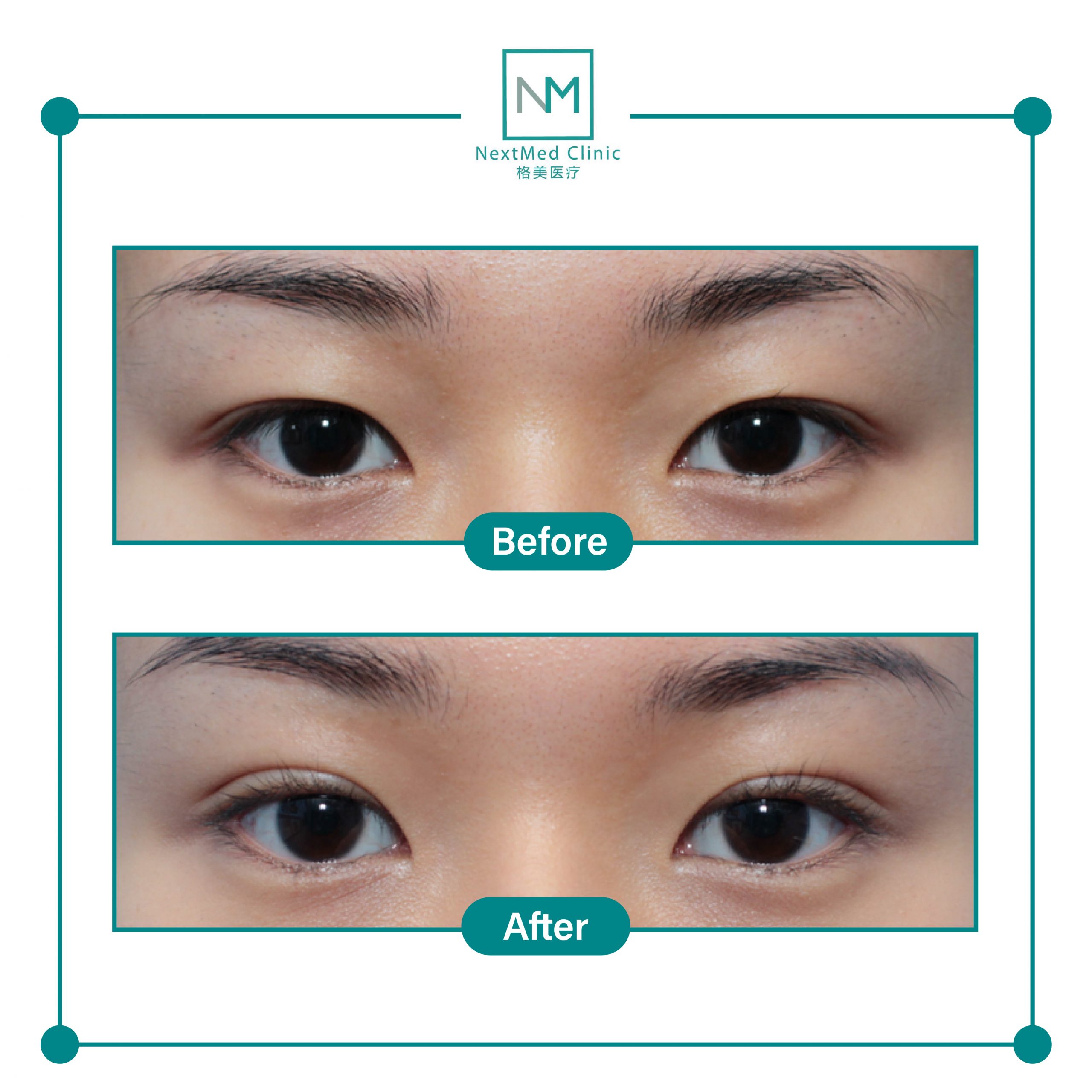 nextmed-clinic-double-eyelid-suture-15-scaled-1.jpg