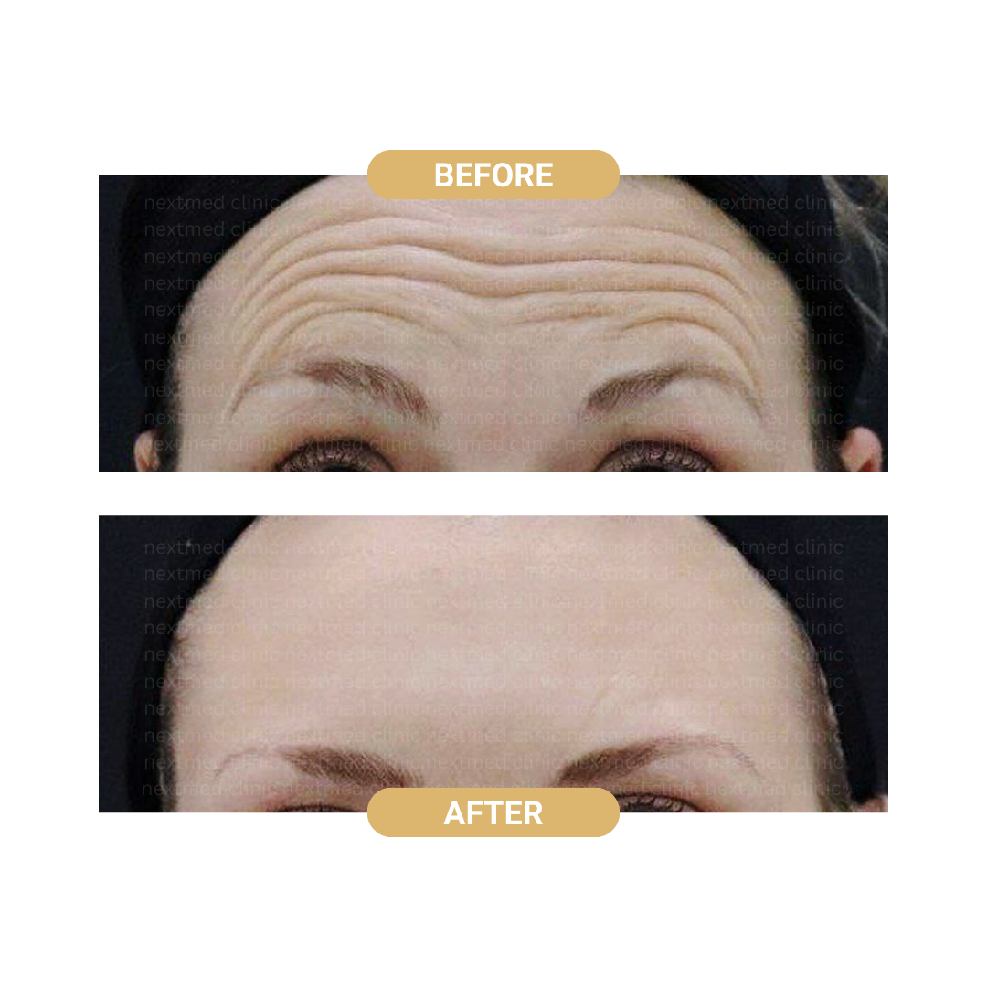 WRINKLE-REDUCTION-2.png