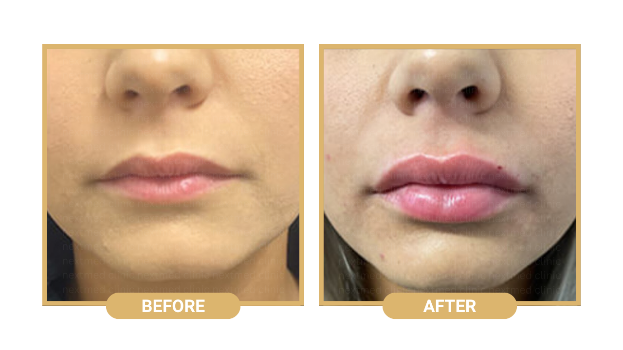 lip-filler-nextmed-before-after-1.png