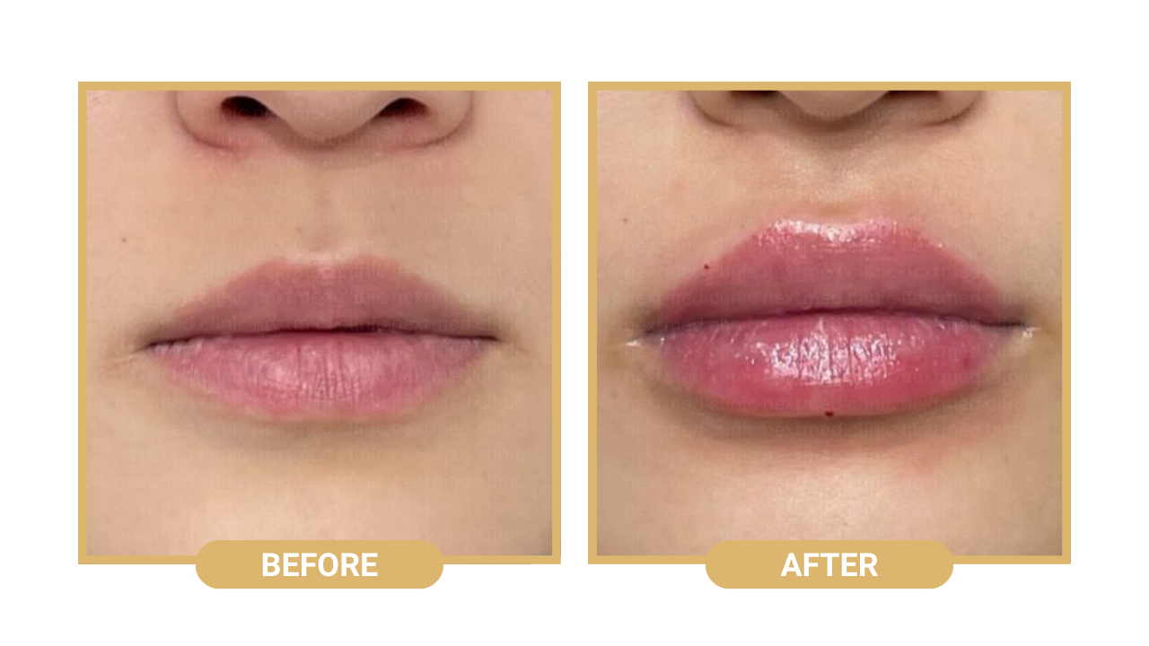 lip-filler-nextmed-before-after-2.png