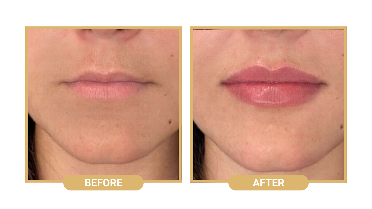 lip-filler-nextmed-before-after-4.png